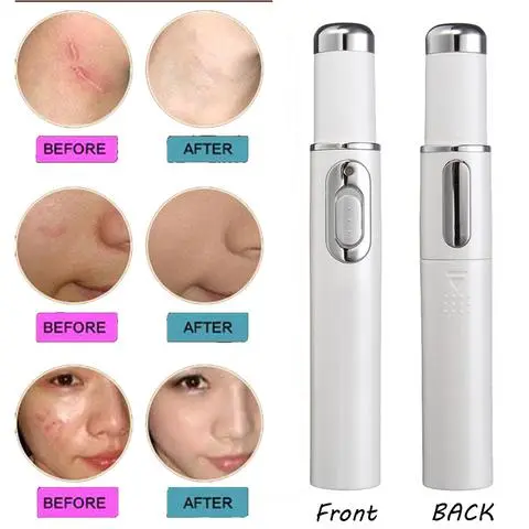 Blue Light Therapy Acne Laser Pen Soft Scar Wrinkle Removal Treatment Device Skin Care Beauty Equipment – image 5