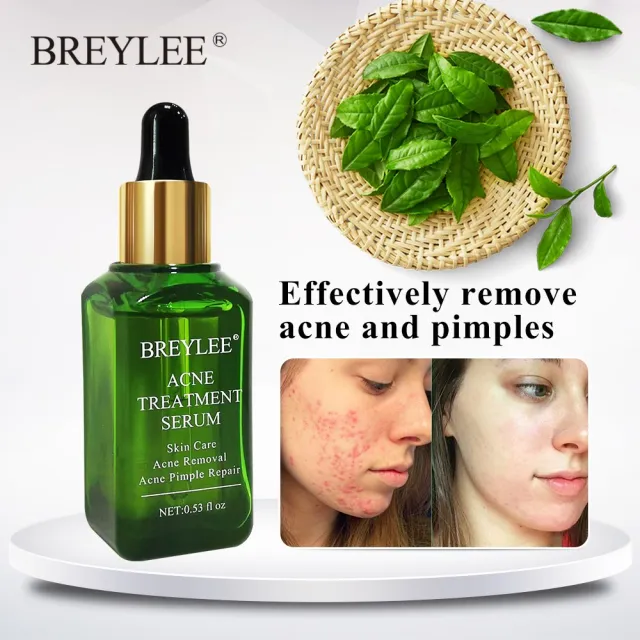 BREYLEE Acne Treatment Serum Face Facial Anti Acne Scar Removal Cream Skin Care Whitening Repair Pimple Remover For Acne 17Ml - Shop at LoveMi