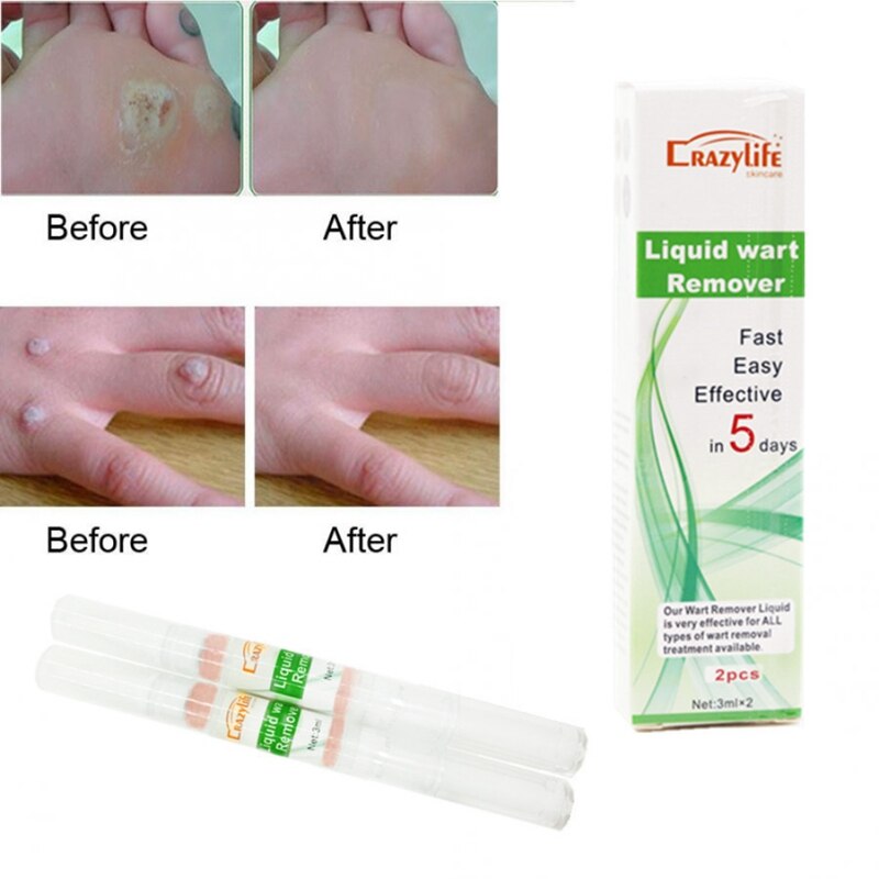 Title 2, Common and flat wart pen for external treatment...