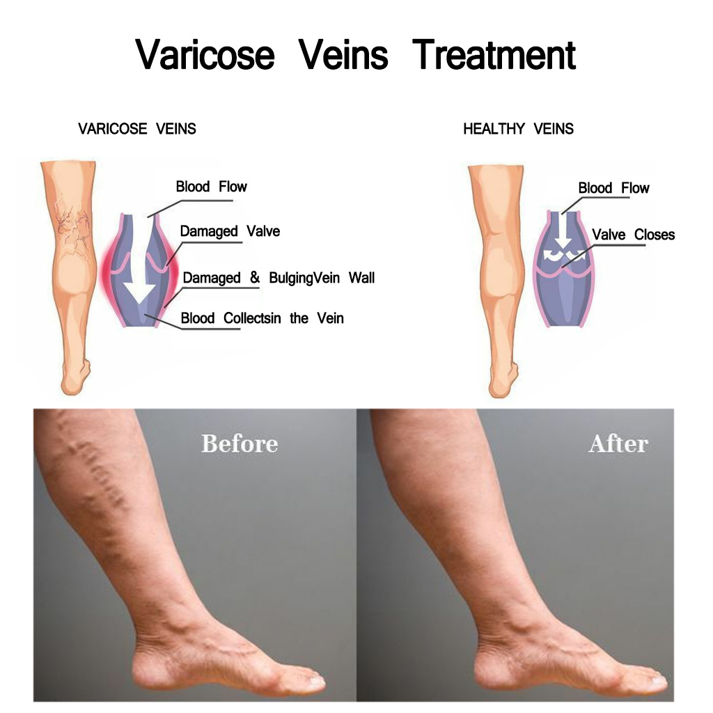 Title 5, Crème pour varices Soulage les jambes fatiguées...