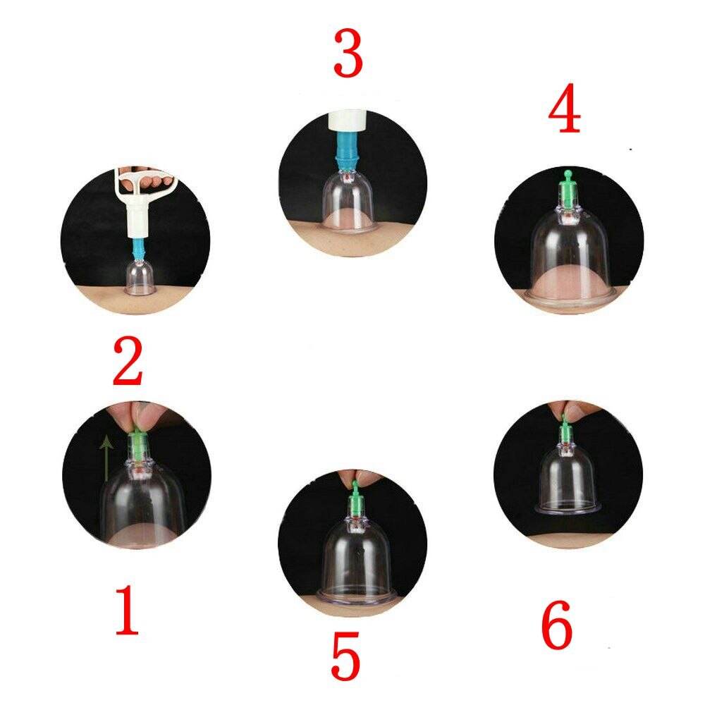 Title 8, Kang Zhuci Cupping Device Relieves Muscle Pain ...