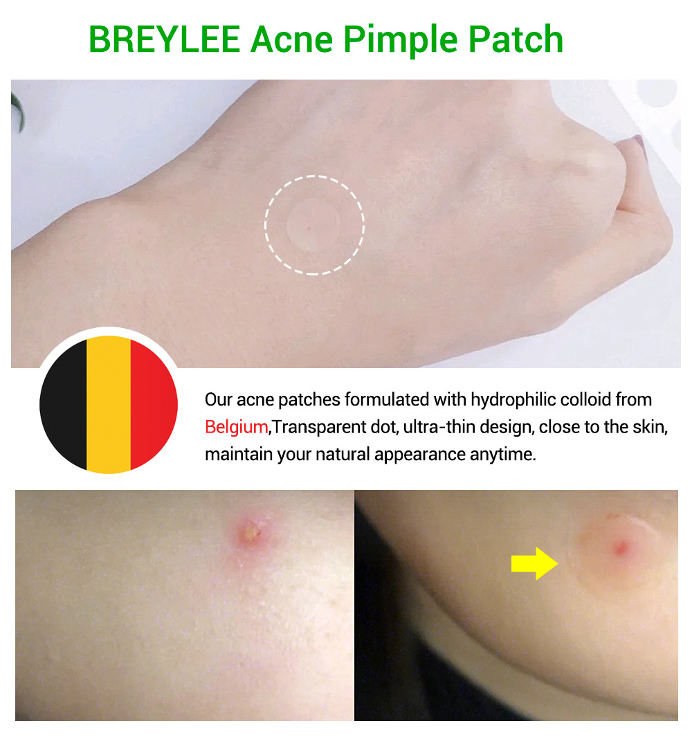 Title 4, Tea Tree Acne Patch