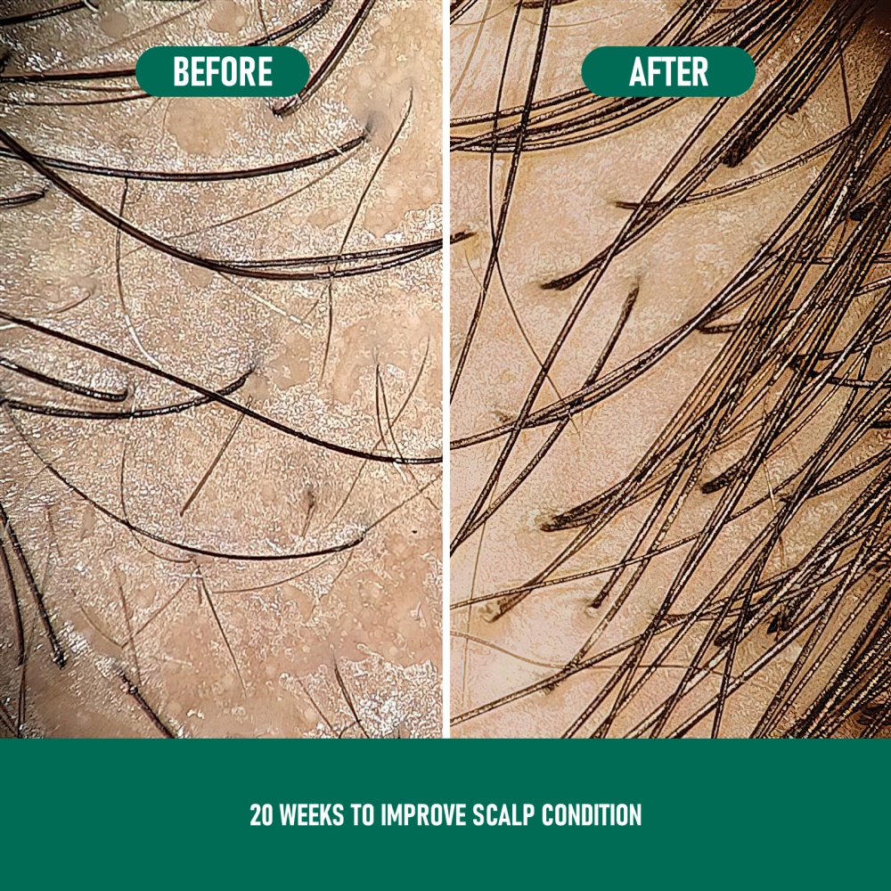 CH004 Minoxidil Anti-Hair Loss Mousse - Image 9