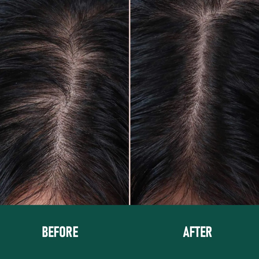 CH004 Minoxidil Anti-Hair Loss Mousse - Image 7