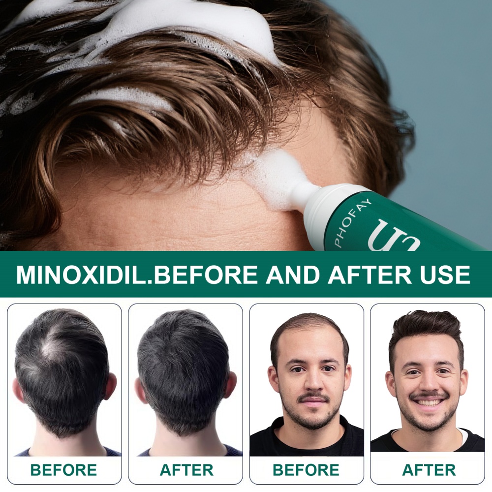 CH004 Minoxidil Anti-Hair Loss Mousse - Image 11