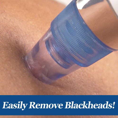Electric blackhead meter to blackhead artifact