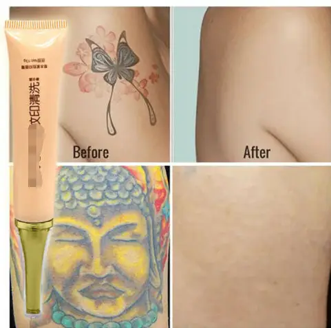 Tattoo Removal Cream