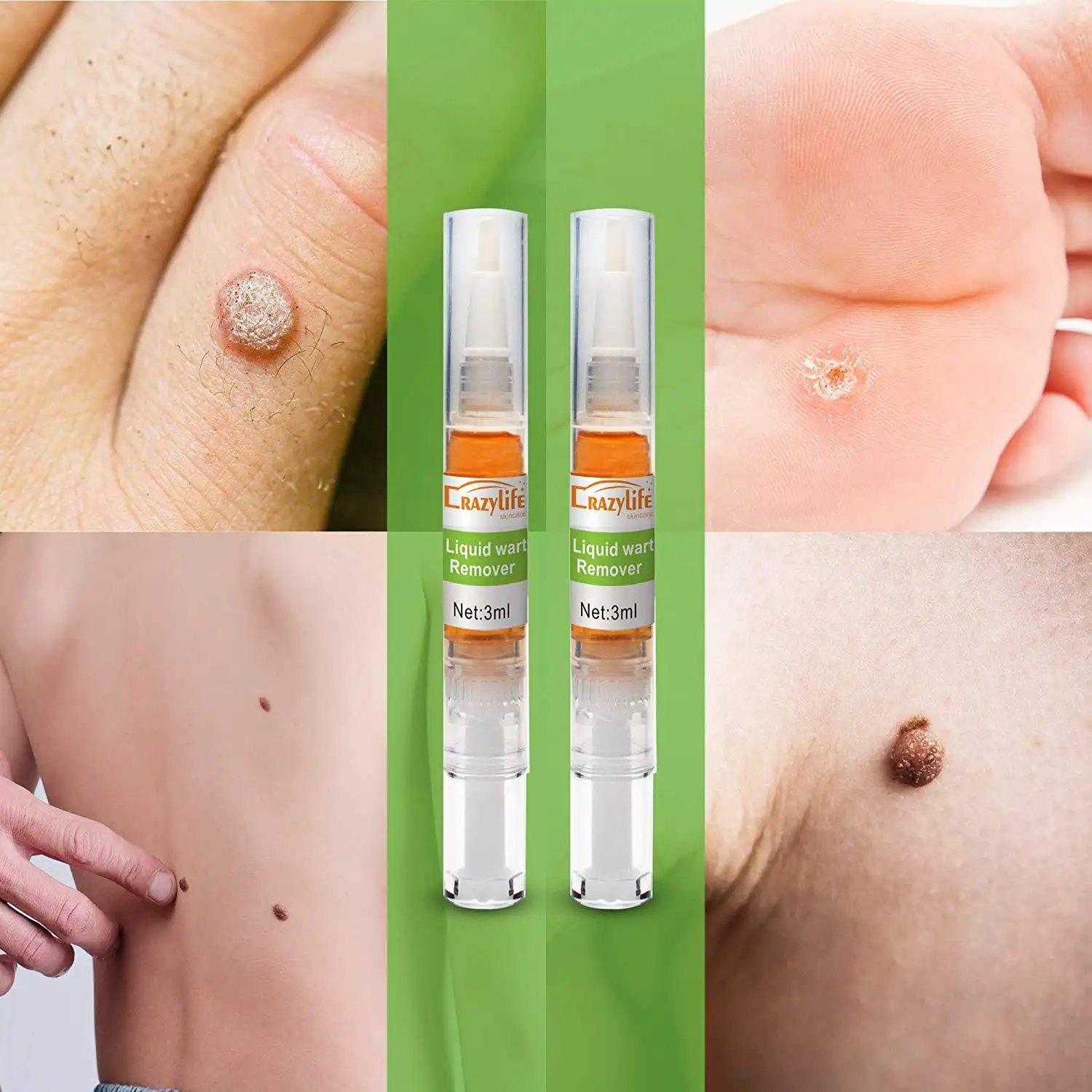 Common wart flat especially external wart pen