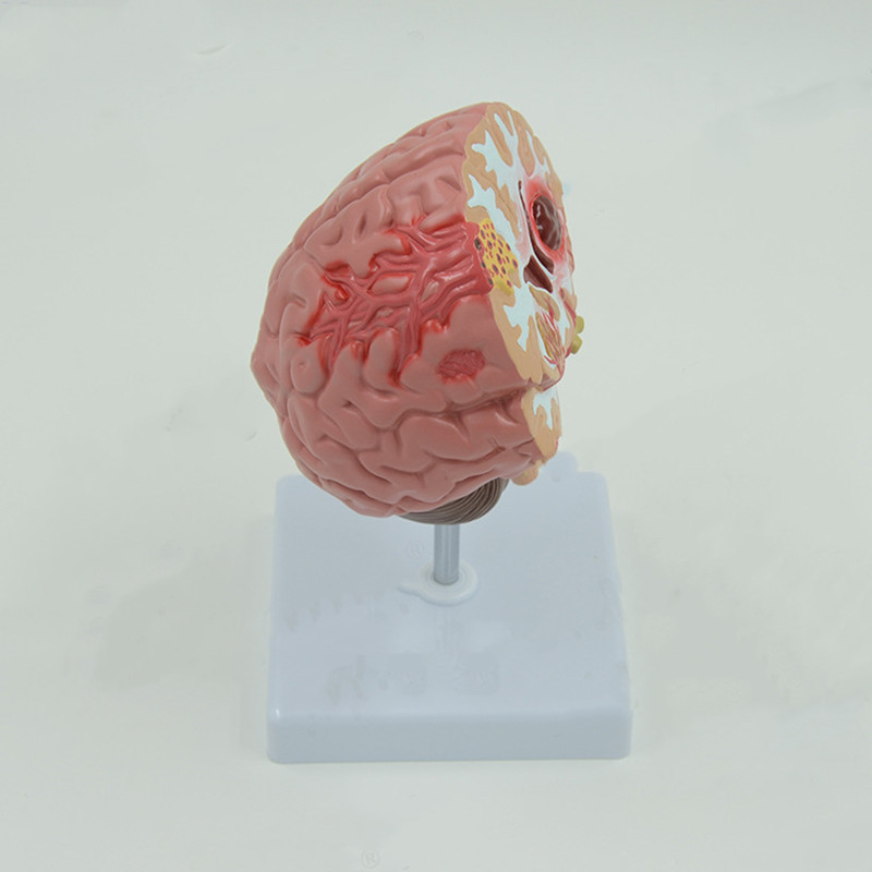 Brain Pathological Anatomical Model of Cerebral Infarction