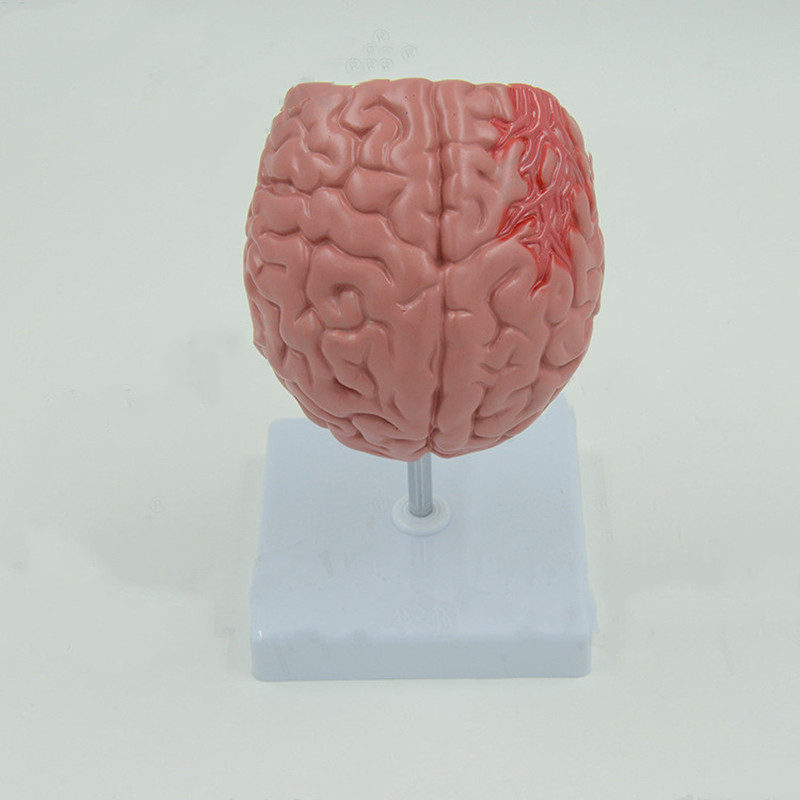 Brain Pathological Anatomical Model of Cerebral Infarction