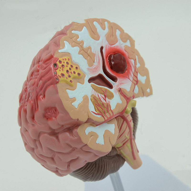 Brain Pathological Anatomical Model of Cerebral Infarction