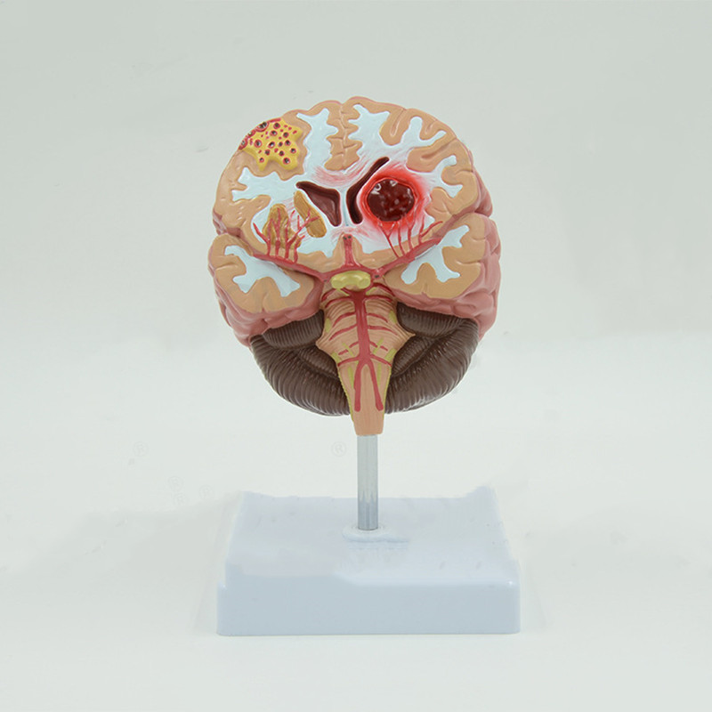 Brain Pathological Anatomical Model of Cerebral Infarction