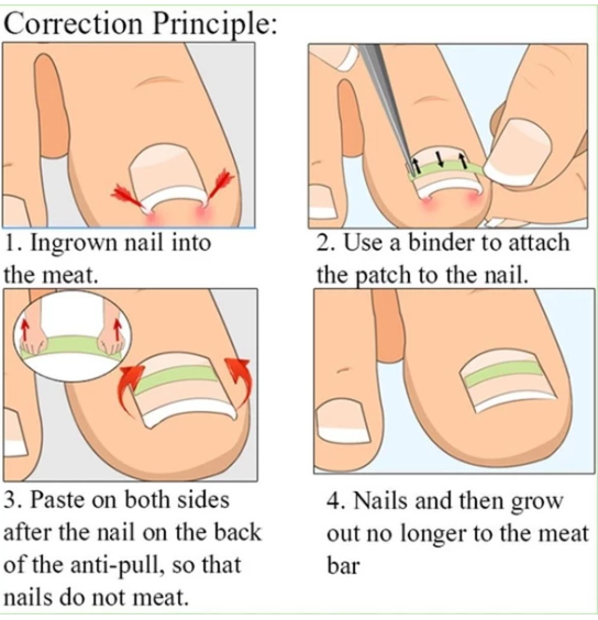 Nail patch — foto 5