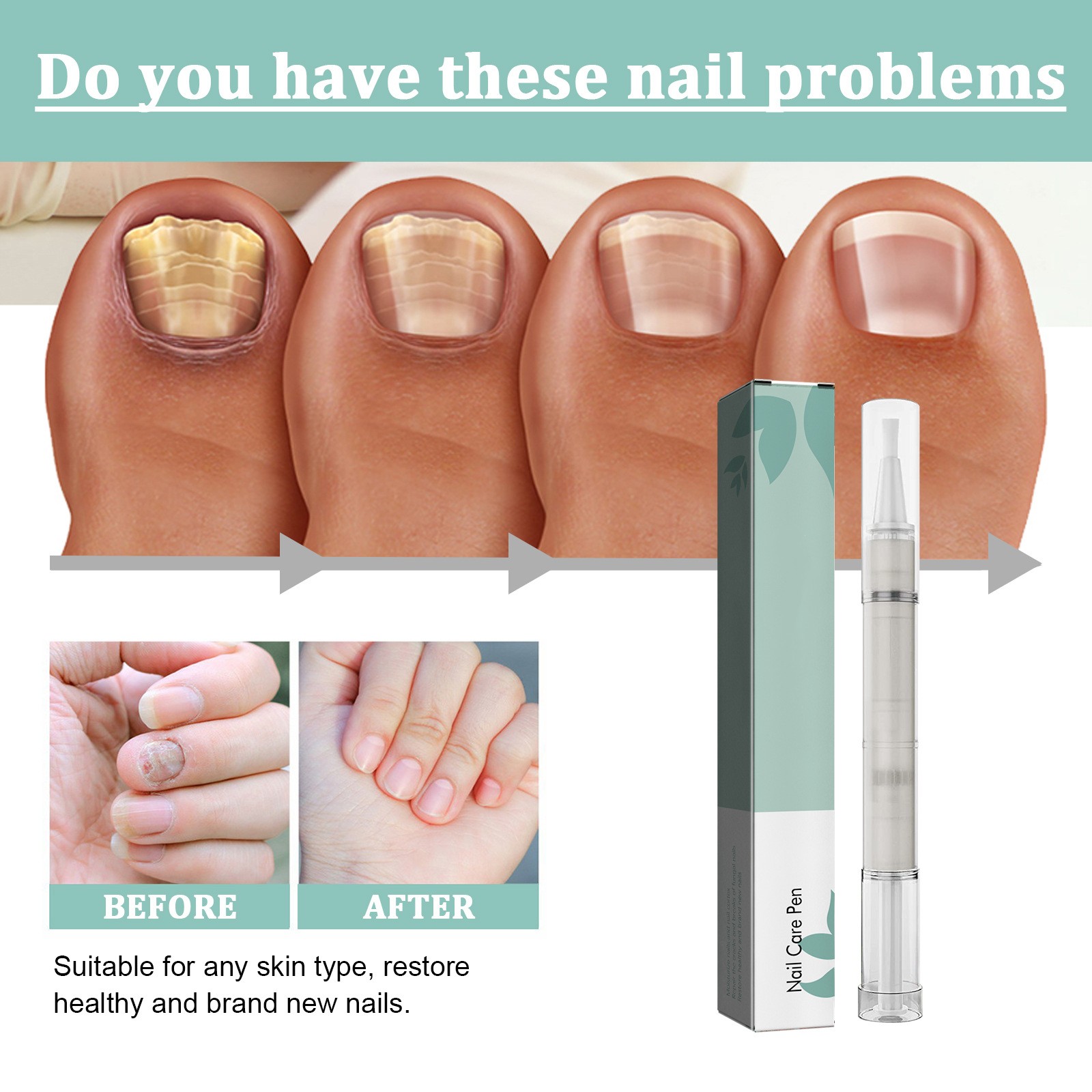 Nail Repair Pen Nail Removal Dead Skin Barbed Moisturizing Repair Pen - Image 3