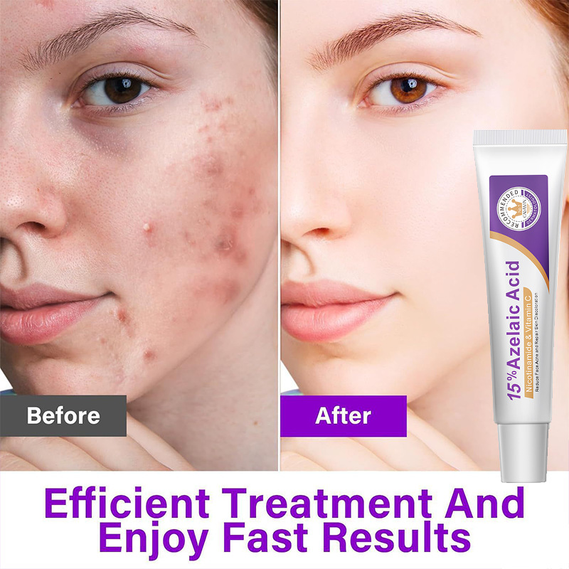 Azelaic Acid Serum