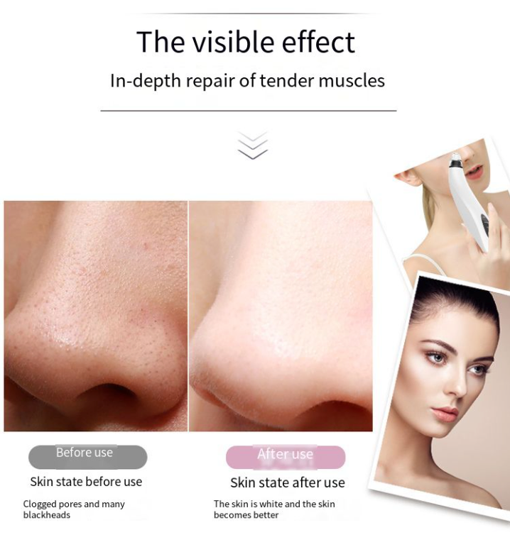 Electric Blackhead Remover Cleaner Face Diamond Pore Vacuum Suction White Heads | Elevated Statement