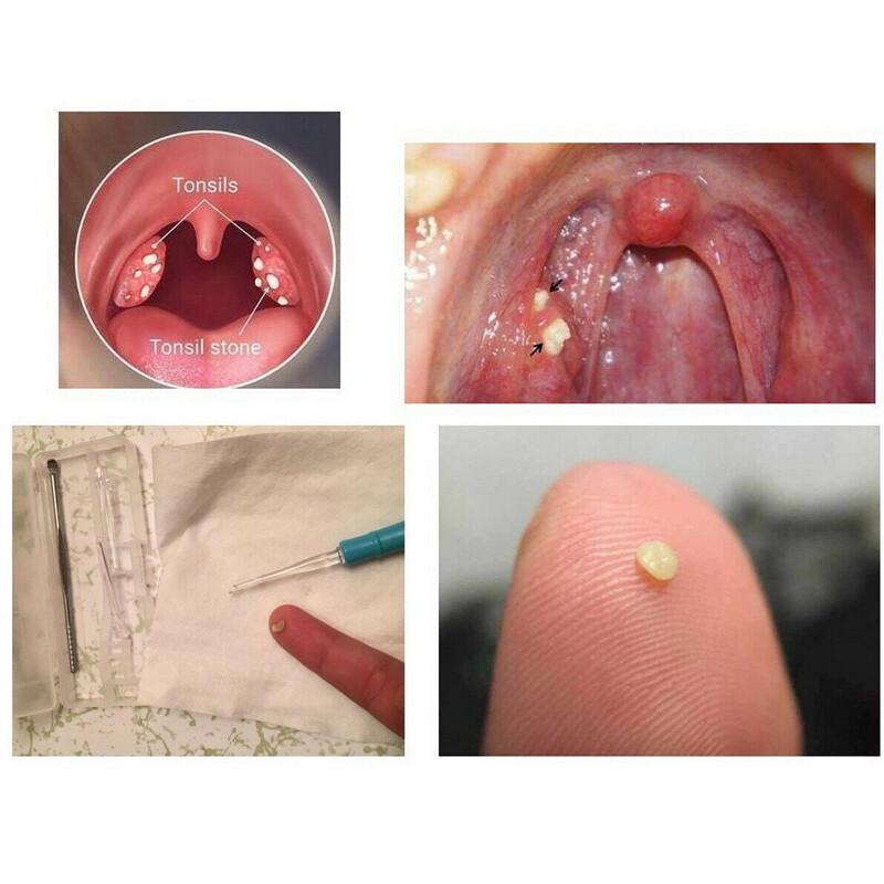 Tonsil Stone Extractor & LED Earwax Removal Tool Kit Oral Care Ear Pick Remover