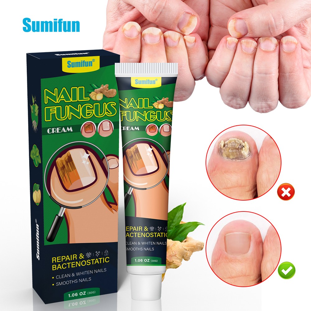 Nail Essential Oil Repair Gel,Fungal Nail Treatment Cream,Foot Repair Toe Nail Fungus Removal