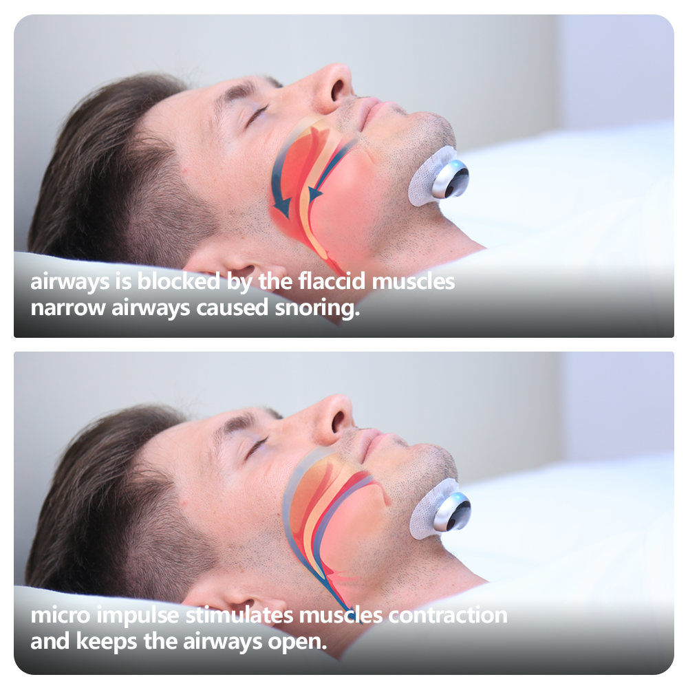 Smart Anti Snoring Device Electronic Muscle Stimulator Plus With 20pcs Conductive Strips - Image 9