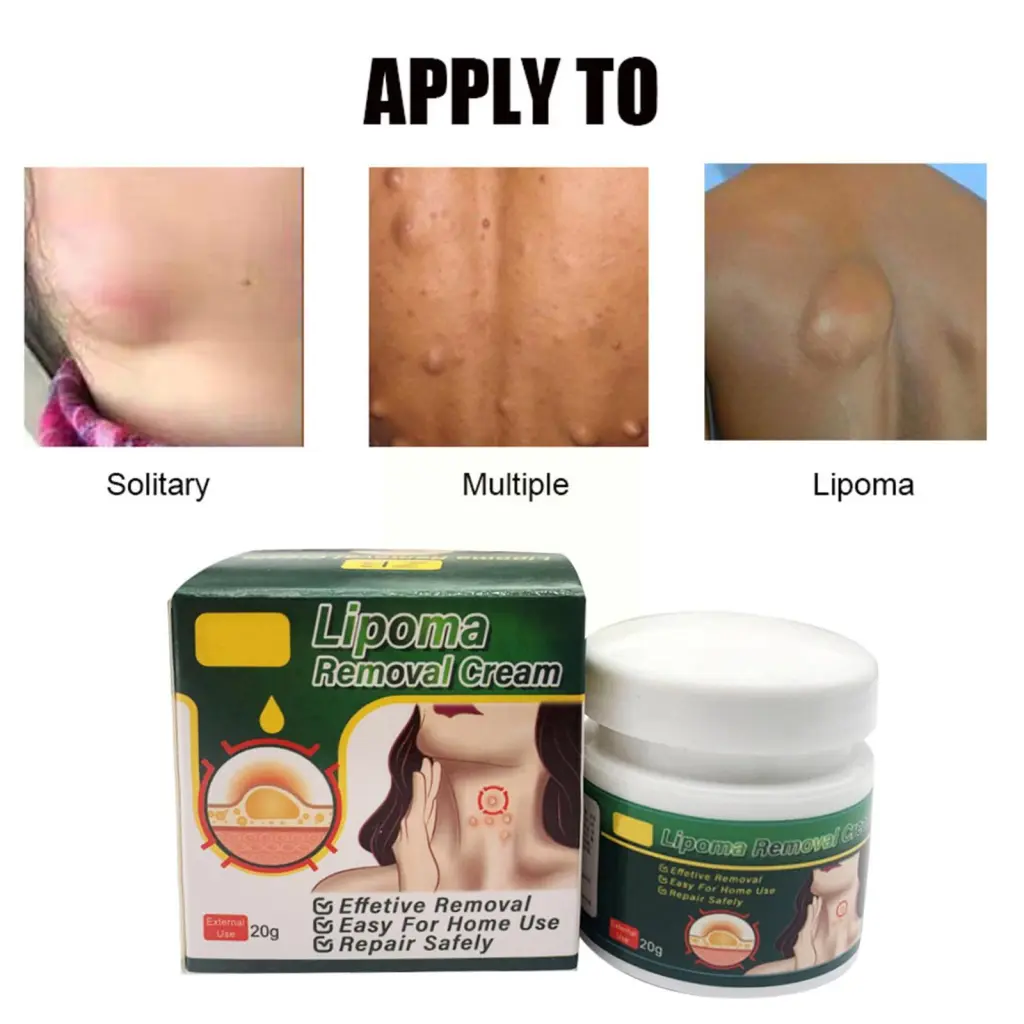 Multiple Anti-tumor Lipoma Pain Cream - 43G