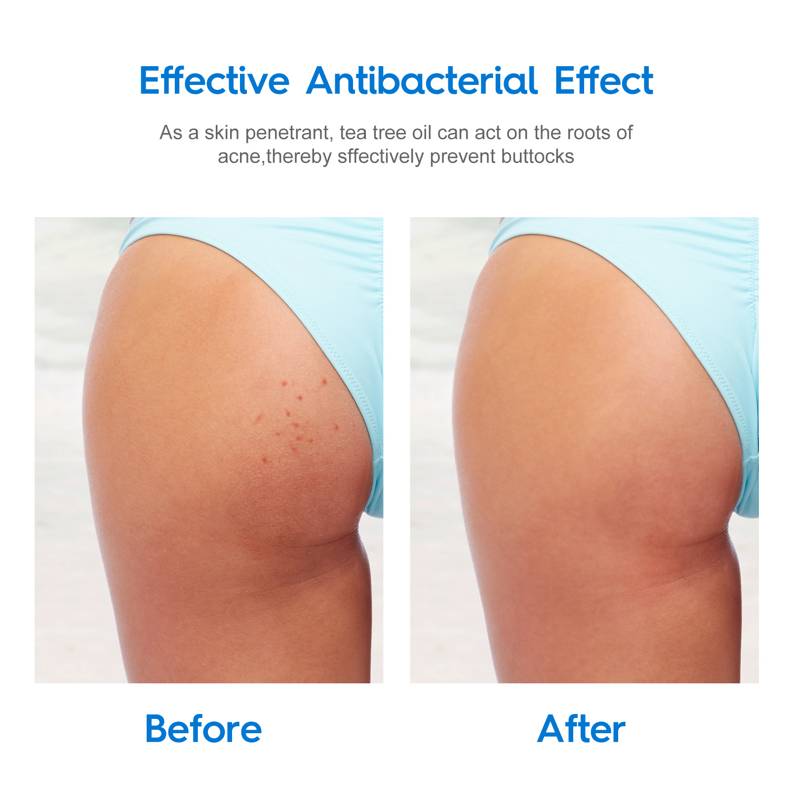 Fade Acne Scars And Butt Lifting Cream