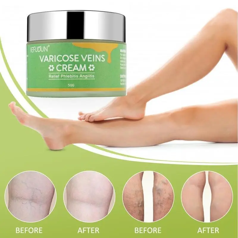 Vein Cream Red Blood Streaks Repair Earthworm Leg Bruises