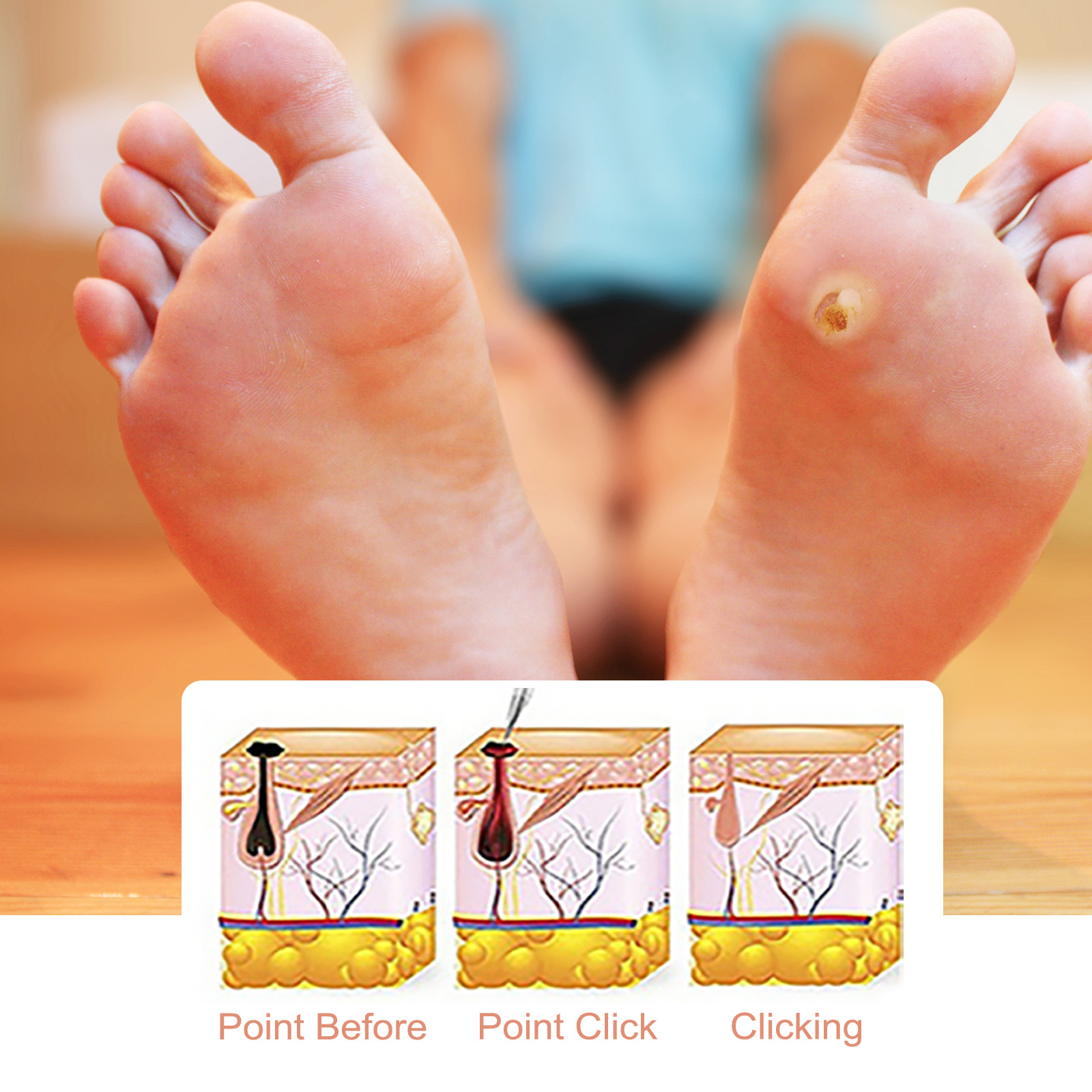 Clear And Remove Corns Skin Care Chicken Cocoon Calluses Foot Pad Wart