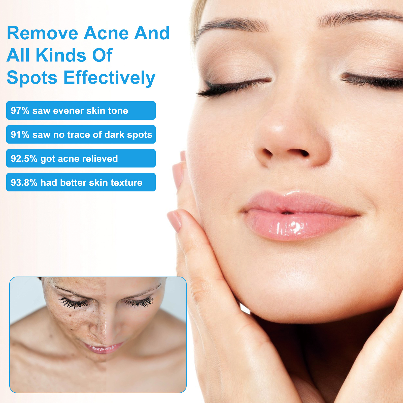 Émulsion anti-boutons — Soin points noirs 30 ml 1