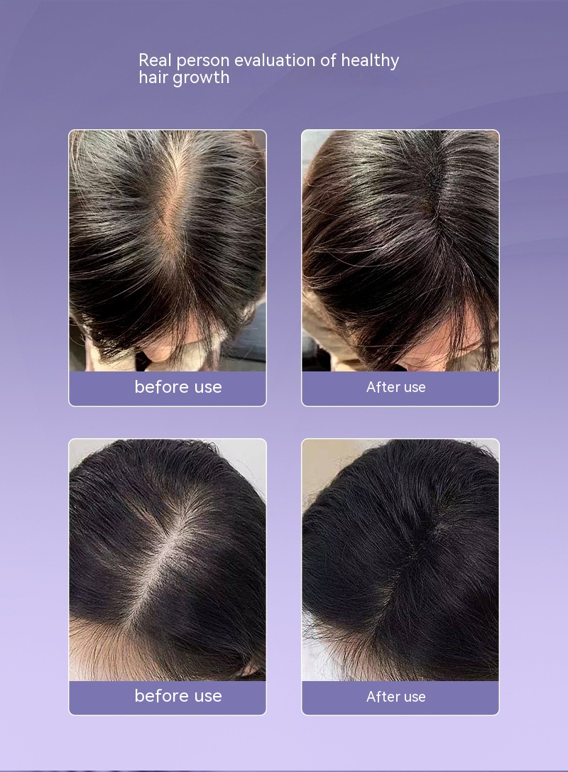 Scalp Medicine Feeder Care Massage Blue Light Red Light Hair Growth Tonic Import Comb — foto 10