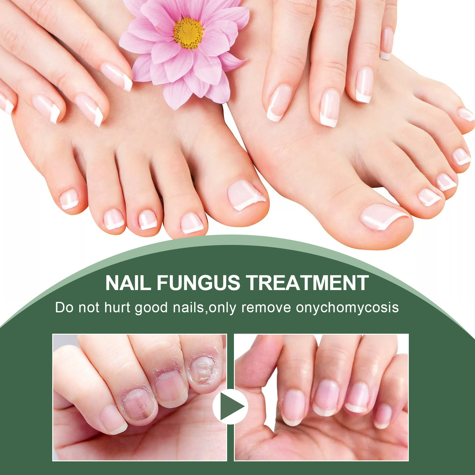 Title 6, Foot Care Solution Onychomycosis Nail Care Solu...