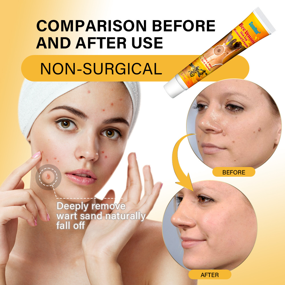 Herbal Wart-Removal Skin Care Cream For Wart Removal