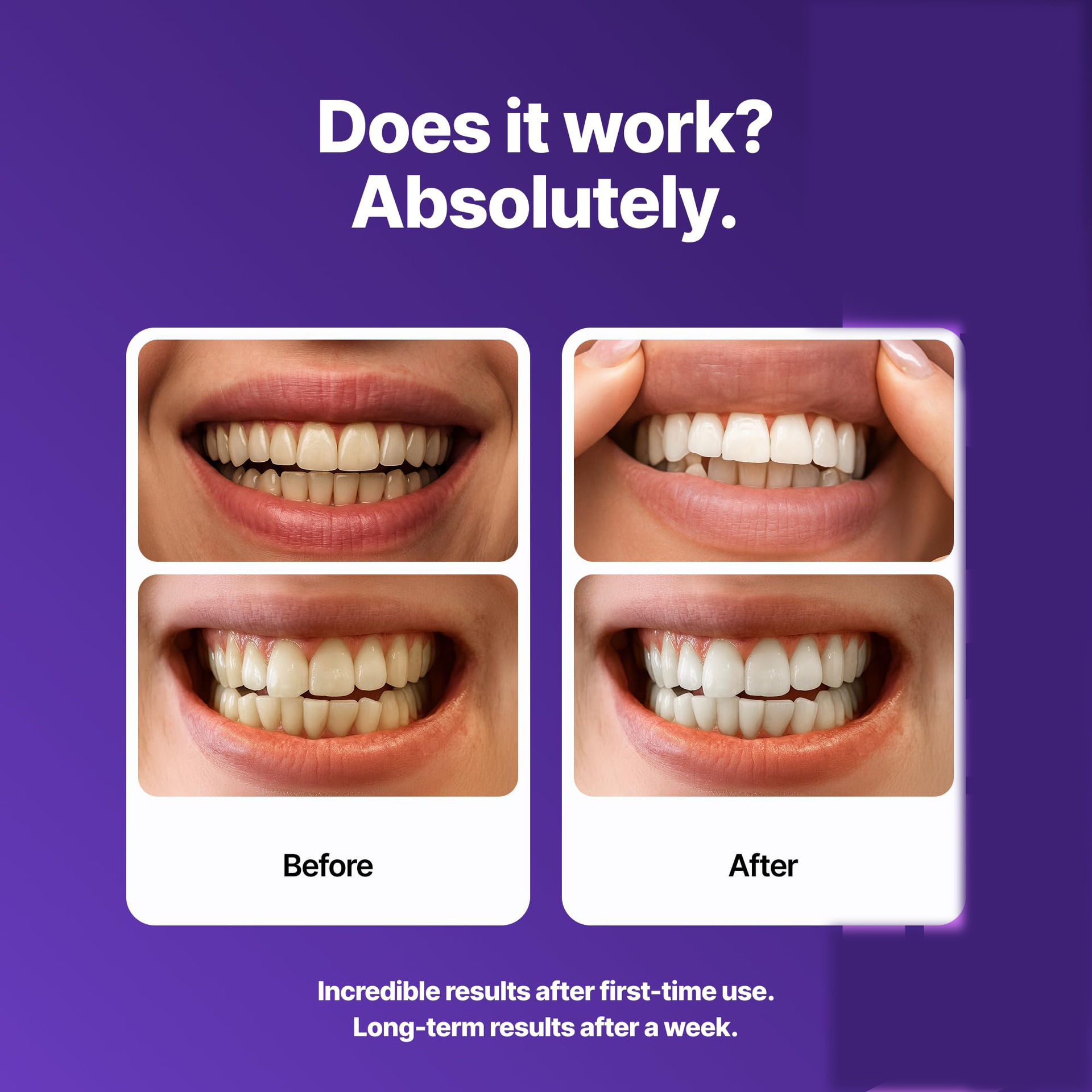 Dental Strips Help Protect The Enamel Layer